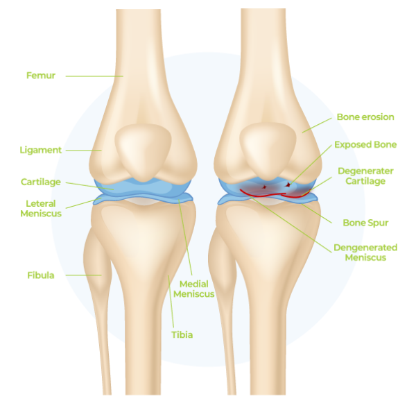 osteoarthritis, oa